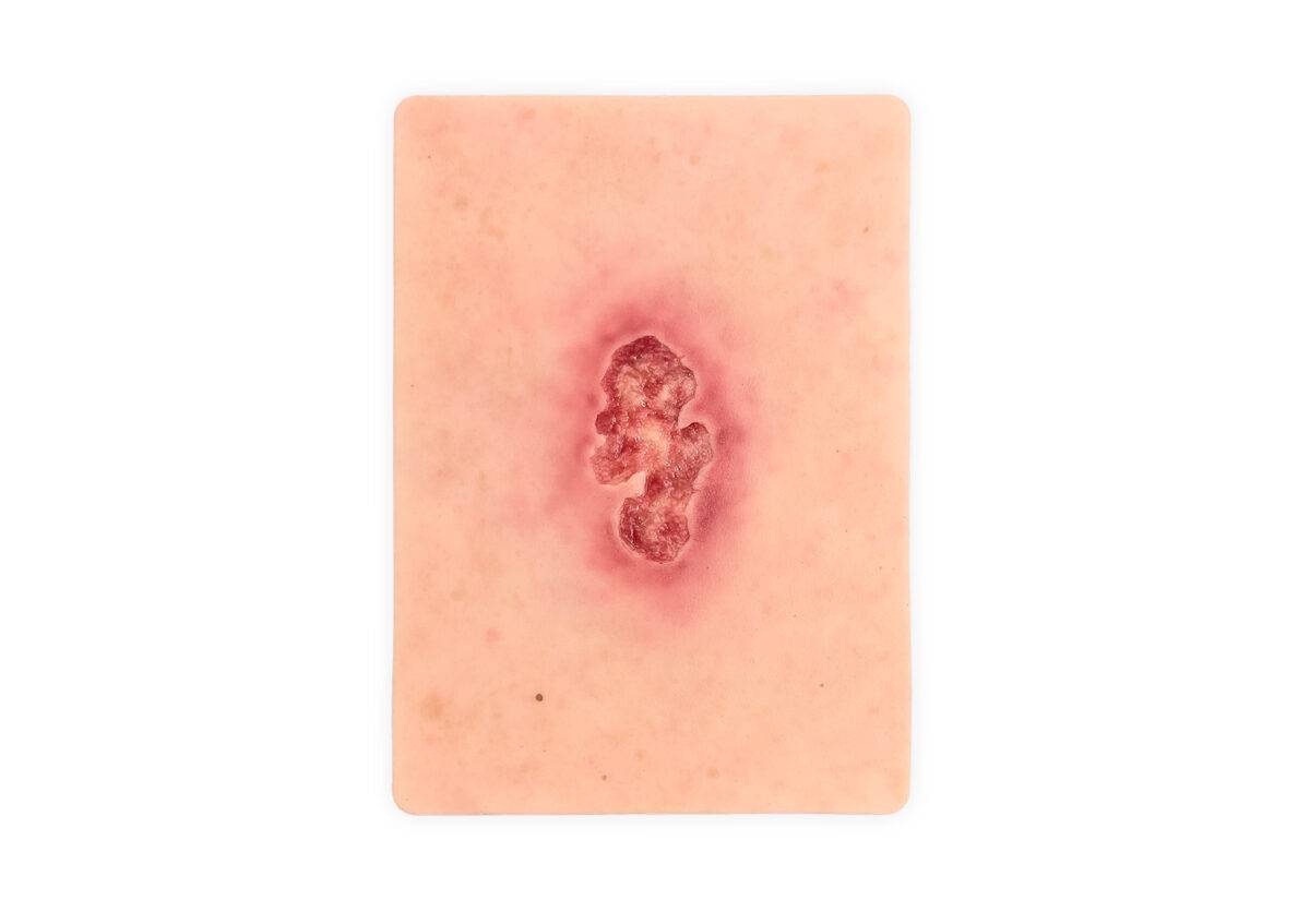 Die „Tabletwunde Ulcer Chronische Wunde“ von MEDICAL FX Germany ist ein detailgetreues, handgefertigtes Wundmodell aus hochwertigem Silikon in der Größe eines Tablets. Sie zeigt e…