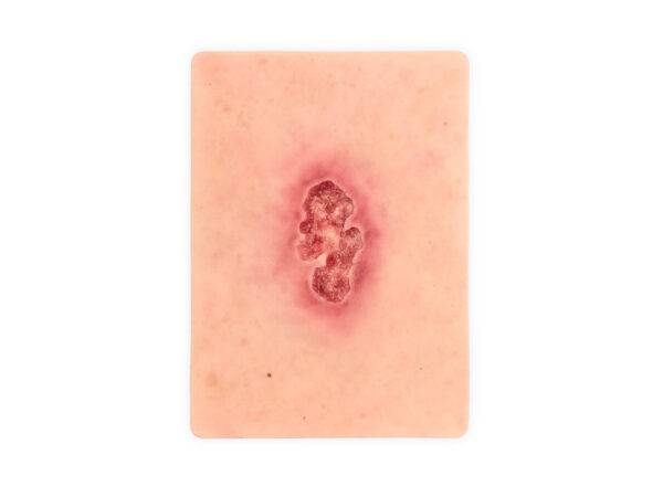 Die „Tabletwunde Ulcer Chronische Wunde“ von MEDICAL FX Germany ist ein detailgetreues, handgefertigtes Wundmodell aus hochwertigem Silikon in der Größe eines Tablets. Sie zeigt e…