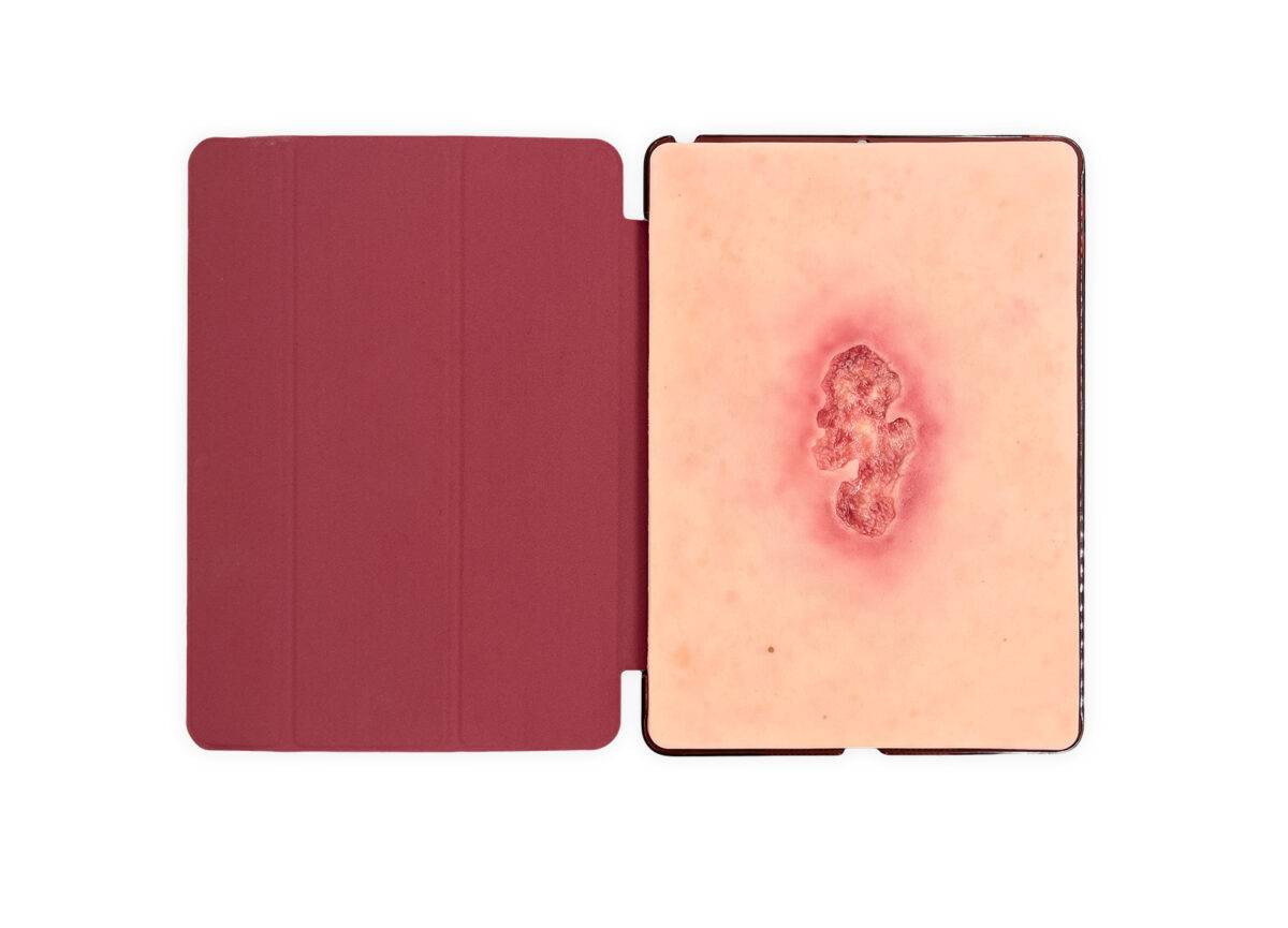 Die „Tabletwunde Ulcer Chronische Wunde“ von MEDICAL FX Germany ist ein detailgetreues, handgefertigtes Wundmodell aus hochwertigem Silikon in der Größe eines Tablets. Sie zeigt e…
