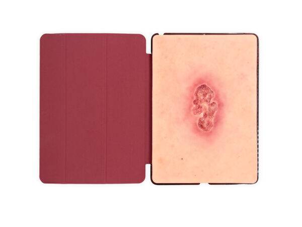Die „Tabletwunde Ulcer Chronische Wunde“ von MEDICAL FX Germany ist ein detailgetreues, handgefertigtes Wundmodell aus hochwertigem Silikon in der Größe eines Tablets. Sie zeigt e…