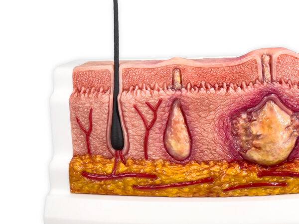 Das „Rahmenmodell Hidradenitis Suppurativa (gebogener Querschnitt)“ von MEDICAL FX Germany veranschaulicht den typischen Verlauf der chronisch-entzündlichen Hauterkrankung Hidrade…