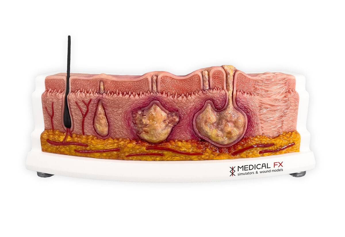 Das „Rahmenmodell Hidradenitis Suppurativa (gebogener Querschnitt)“ von MEDICAL FX Germany veranschaulicht den typischen Verlauf der chronisch-entzündlichen Hauterkrankung Hidrade…