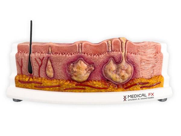 Das „Rahmenmodell Hidradenitis Suppurativa (gebogener Querschnitt)“ von MEDICAL FX Germany veranschaulicht den typischen Verlauf der chronisch-entzündlichen Hauterkrankung Hidrade…