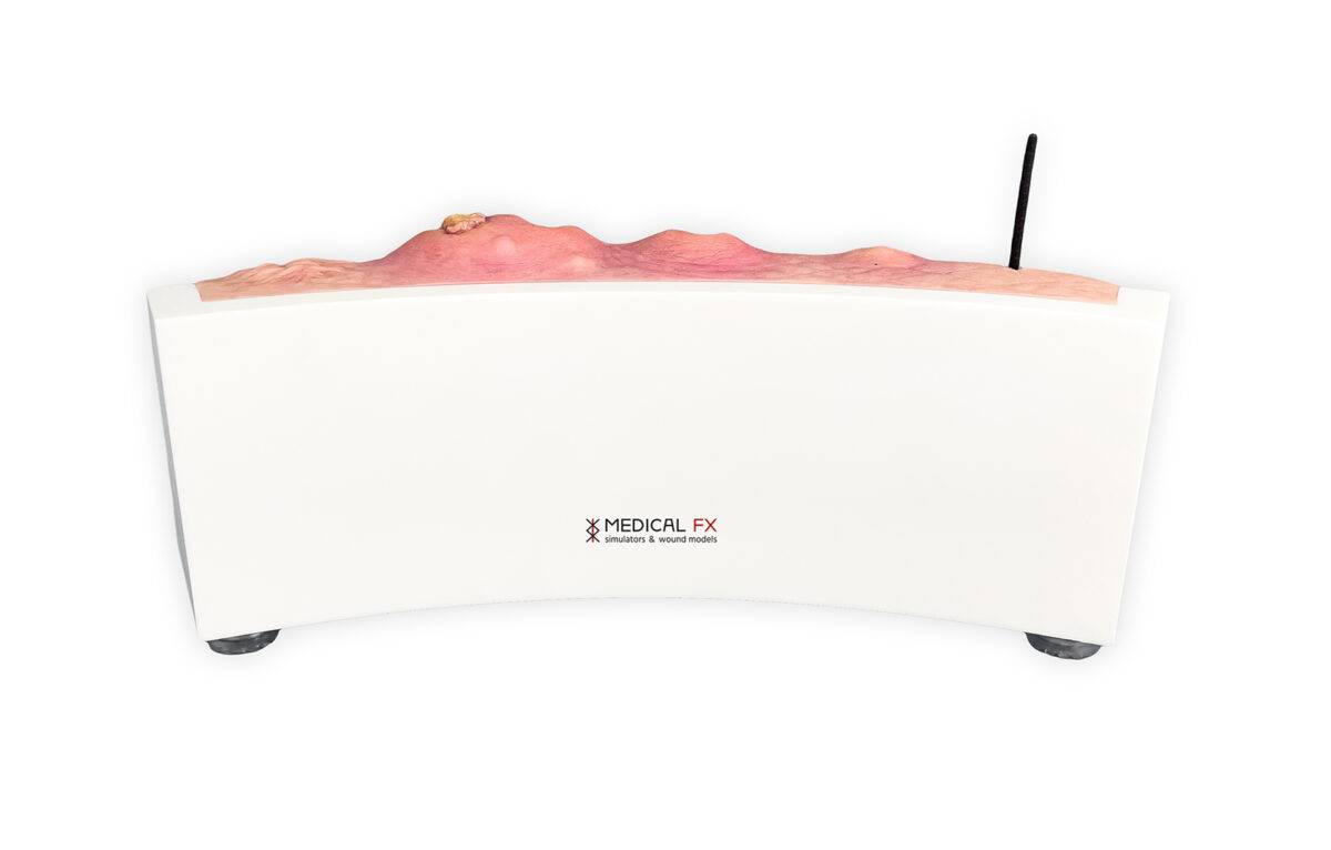 Das „Rahmenmodell Hidradenitis Suppurativa (gebogener Querschnitt)“ von MEDICAL FX Germany veranschaulicht den typischen Verlauf der chronisch-entzündlichen Hauterkrankung Hidrade…