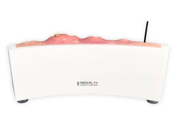 Das „Rahmenmodell Hidradenitis Suppurativa (gebogener Querschnitt)“ von MEDICAL FX Germany veranschaulicht den typischen Verlauf der chronisch-entzündlichen Hauterkrankung Hidrade…