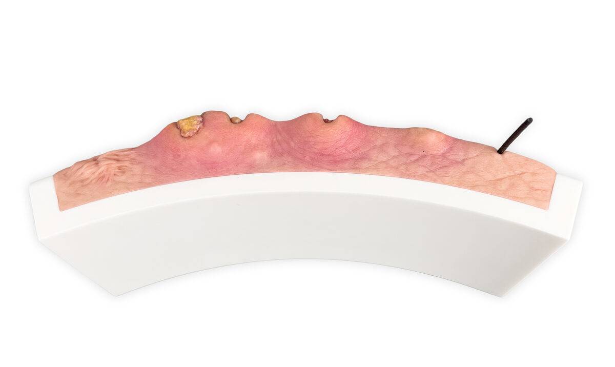 Das „Rahmenmodell Hidradenitis Suppurativa (gebogener Querschnitt)“ von MEDICAL FX Germany veranschaulicht den typischen Verlauf der chronisch-entzündlichen Hauterkrankung Hidrade…