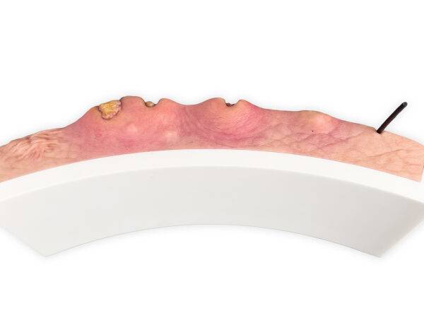 Das „Rahmenmodell Hidradenitis Suppurativa (gebogener Querschnitt)“ von MEDICAL FX Germany veranschaulicht den typischen Verlauf der chronisch-entzündlichen Hauterkrankung Hidrade…