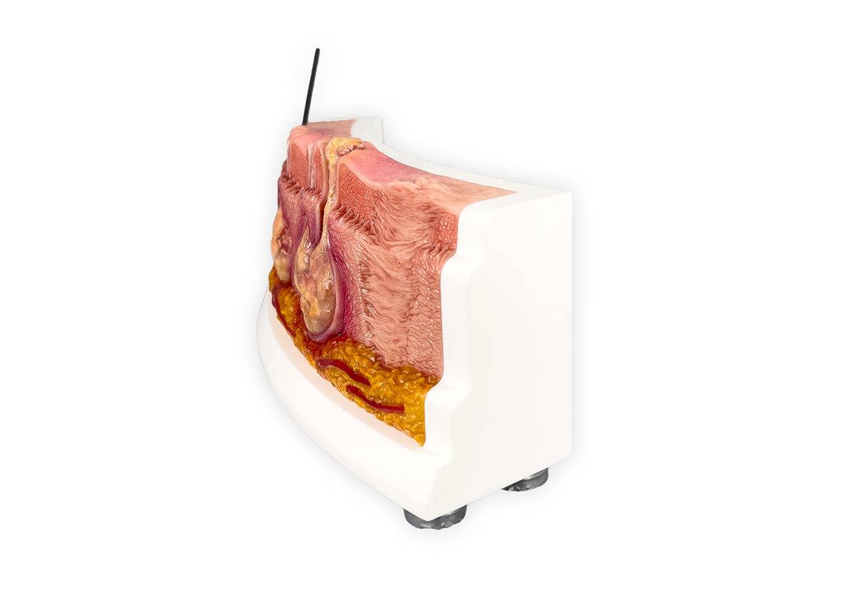 Das „Rahmenmodell Hidradenitis Suppurativa (gebogener Querschnitt)“ von MEDICAL FX Germany veranschaulicht den typischen Verlauf der chronisch-entzündlichen Hauterkrankung Hidrade…