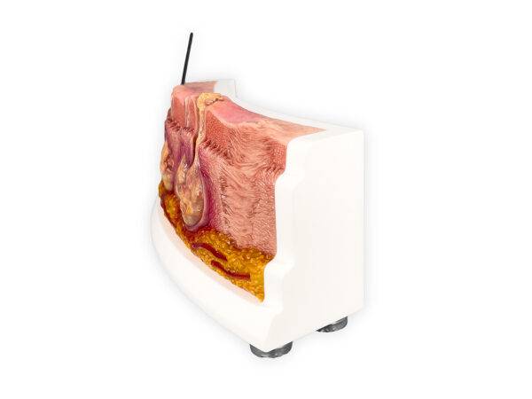 Das „Rahmenmodell Hidradenitis Suppurativa (gebogener Querschnitt)“ von MEDICAL FX Germany veranschaulicht den typischen Verlauf der chronisch-entzündlichen Hauterkrankung Hidrade…