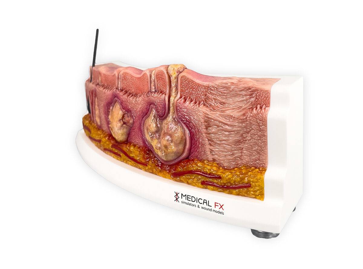 Das „Rahmenmodell Hidradenitis Suppurativa (gebogener Querschnitt)“ von MEDICAL FX Germany veranschaulicht den typischen Verlauf der chronisch-entzündlichen Hauterkrankung Hidrade…