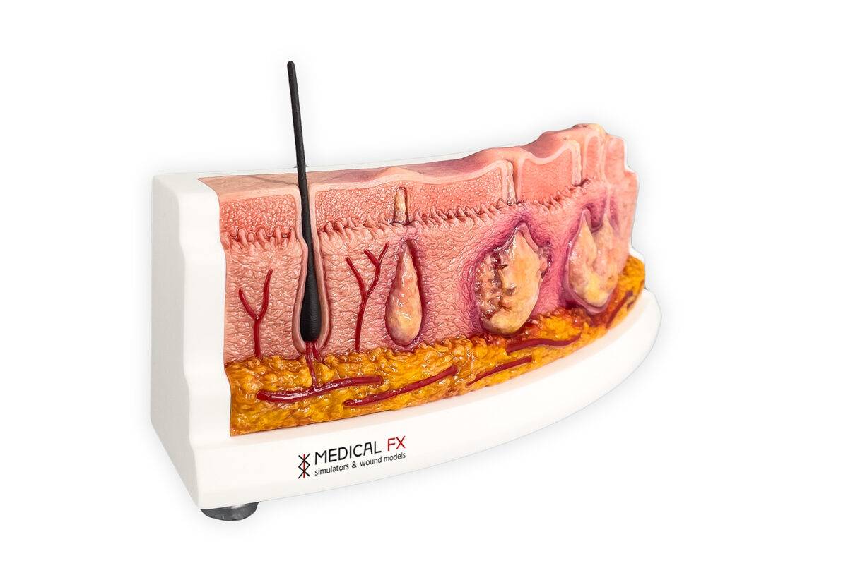 Das „Rahmenmodell Hidradenitis Suppurativa (gebogener Querschnitt)“ von MEDICAL FX Germany veranschaulicht den typischen Verlauf der chronisch-entzündlichen Hauterkrankung Hidrade…