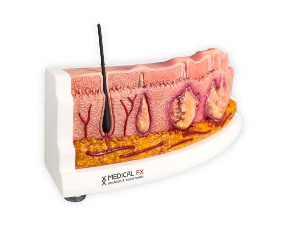 Das „Rahmenmodell Hidradenitis Suppurativa (gebogener Querschnitt)“ von MEDICAL FX Germany veranschaulicht den typischen Verlauf der chronisch-entzündlichen Hauterkrankung Hidrade…