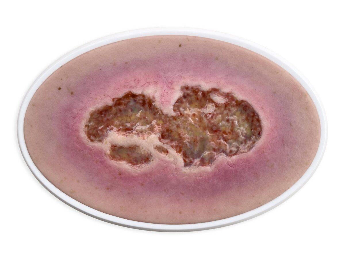 Das „Rahmenmodell Ulcus Cruris" von MEDICAL FX Germany bietet eine detailgetreue Darstellung eines Unterschenkelgeschwürs, einer häufigen chronischen Wundform, die insbesondere im…