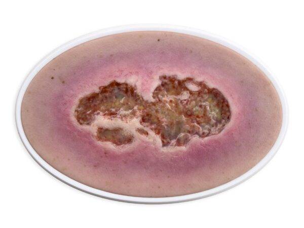 Das „Rahmenmodell Ulcus Cruris" von MEDICAL FX Germany bietet eine detailgetreue Darstellung eines Unterschenkelgeschwürs, einer häufigen chronischen Wundform, die insbesondere im…