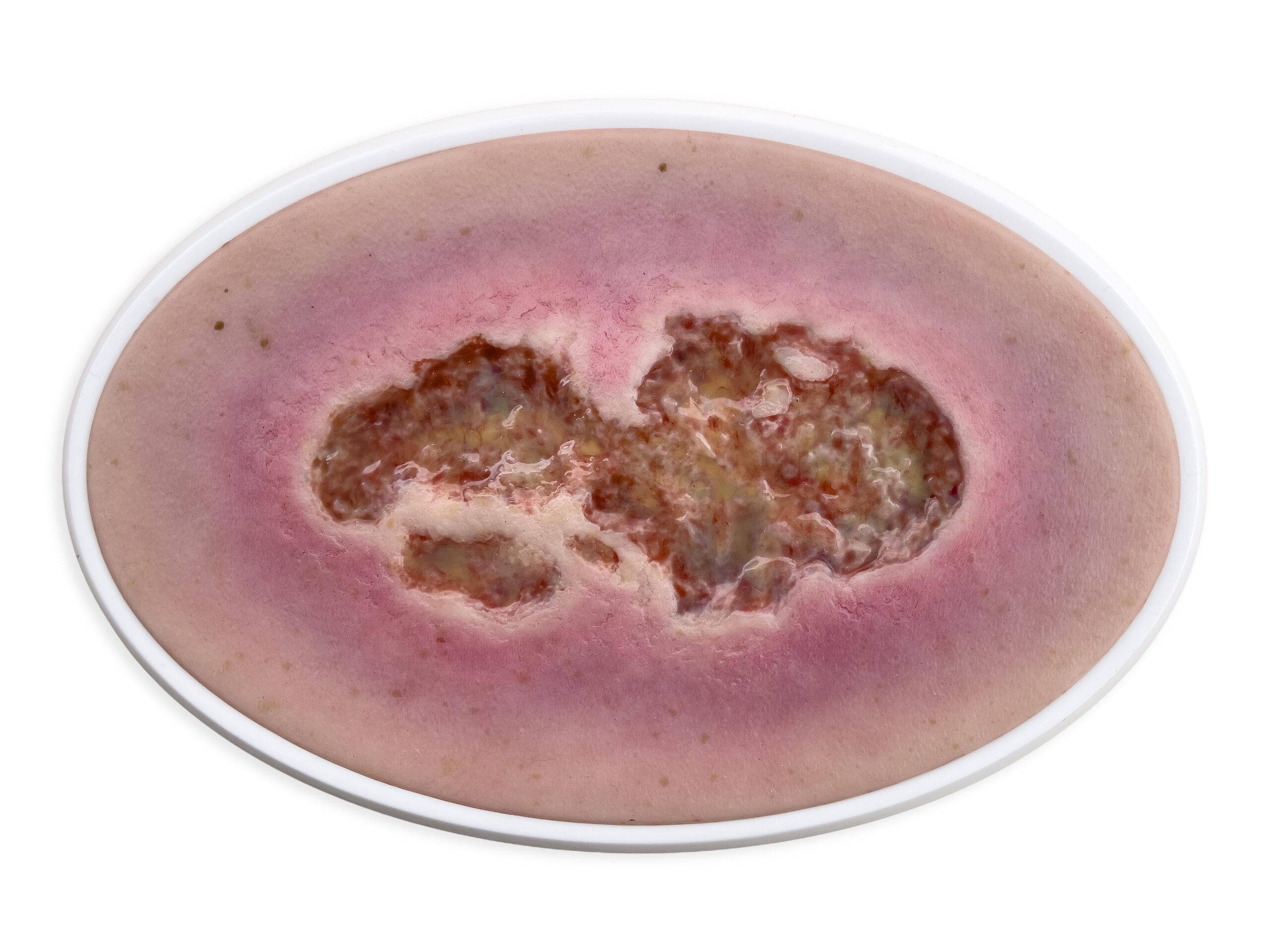 Das „Rahmenmodell Ulcus Cruris" von MEDICAL FX Germany bietet eine detailgetreue Darstellung eines Unterschenkelgeschwürs, einer häufigen chronischen Wundform, die insbesondere im…