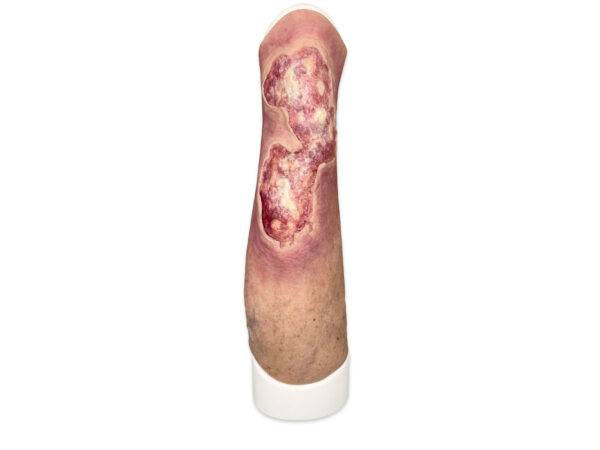 Sleeve Bein mit Gamaschenulkus mit belag MEDICALFX GERMANY frontal 1