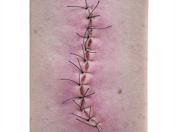 lq 1 pocketwunden op wunde entzuendet