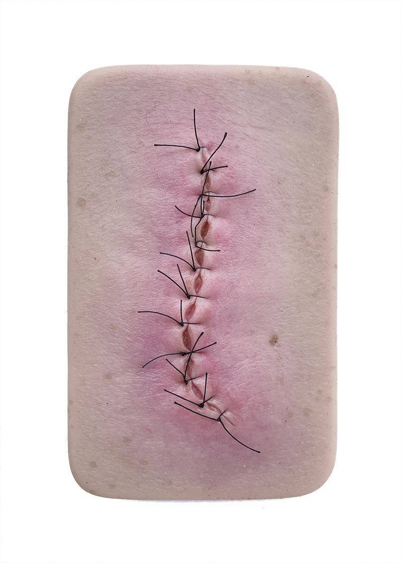 lq 1 pocketwunden op wunde entzuendet