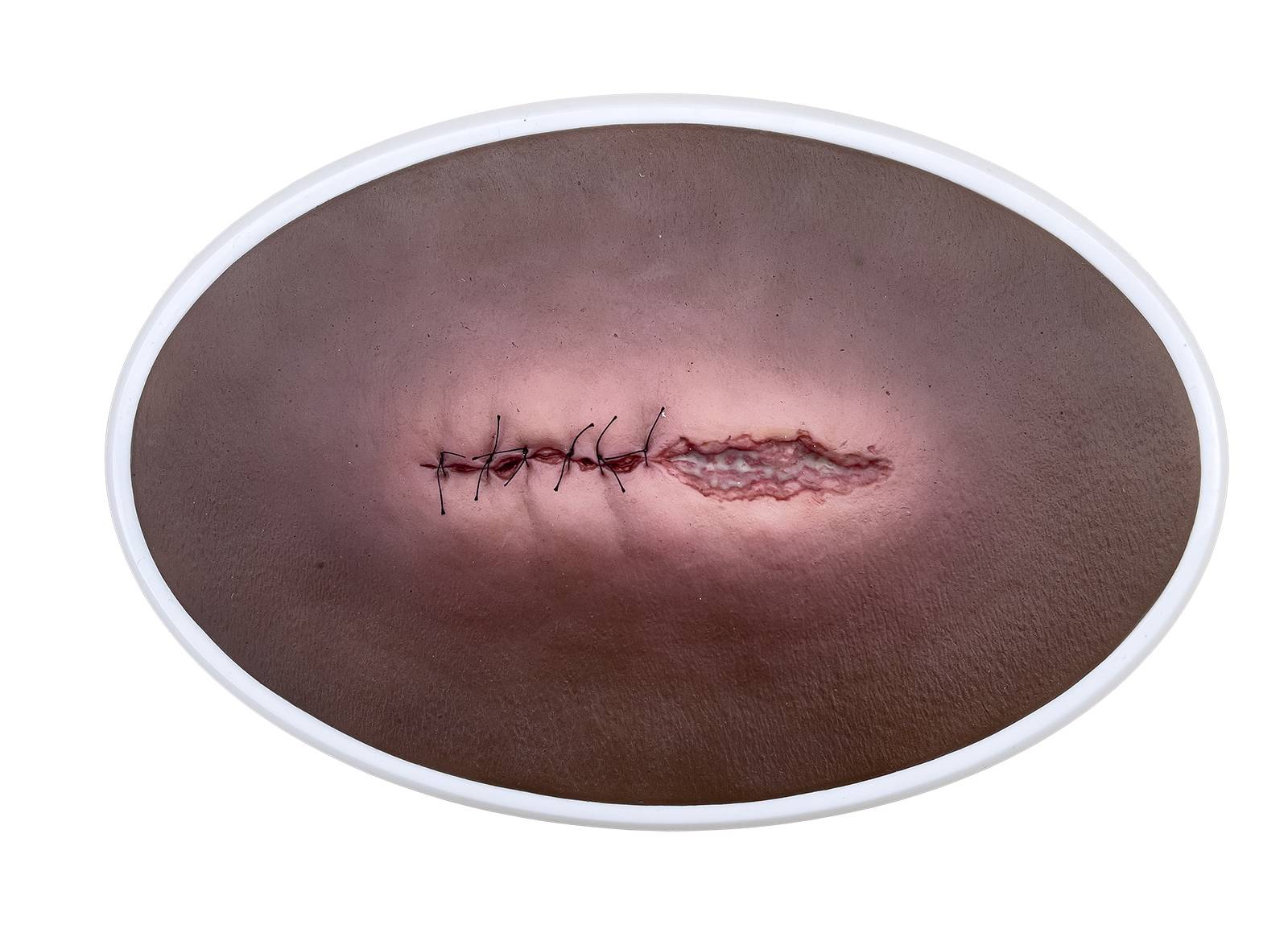 Das „Rahmenmodell OP-Wunde Geöffnet" von MEDICAL FX Germany bietet eine realistische Darstellung einer chirurgischen Wunde in geöffnetem Zustand. Dieses Modell ist in einen robust…