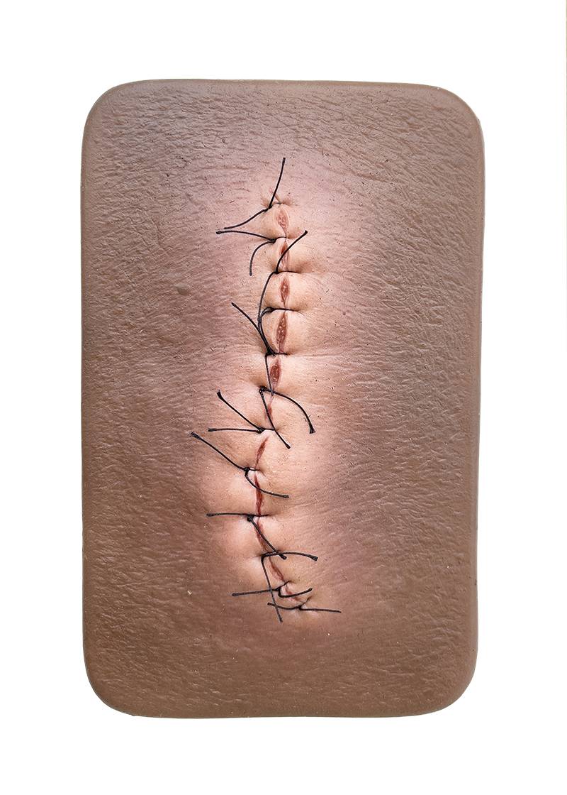 Pocketwunde OP-Wunde geschlossen und entzündet