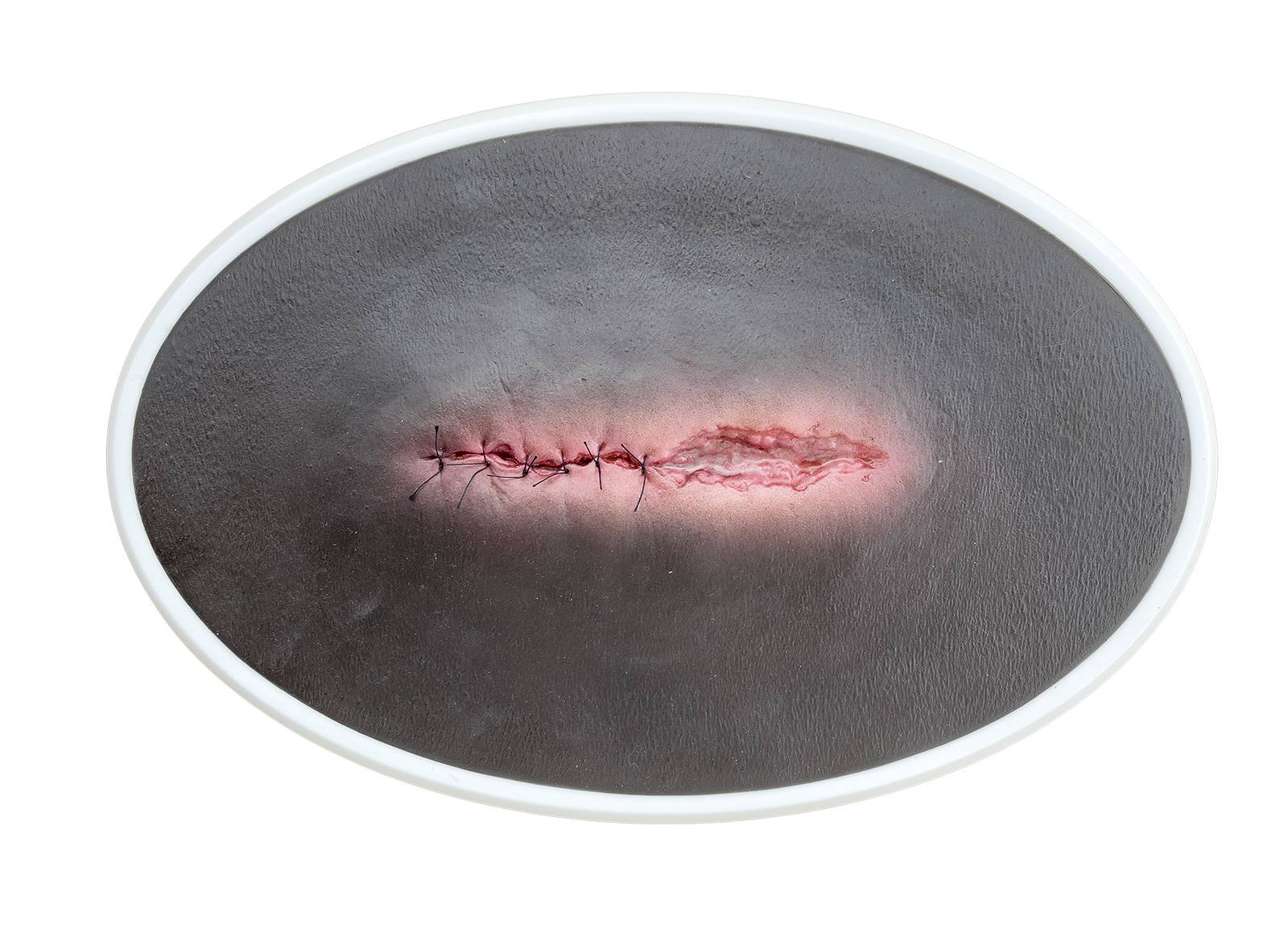 lq 4 OP Wunde im Rahmen offen entzuendet 1