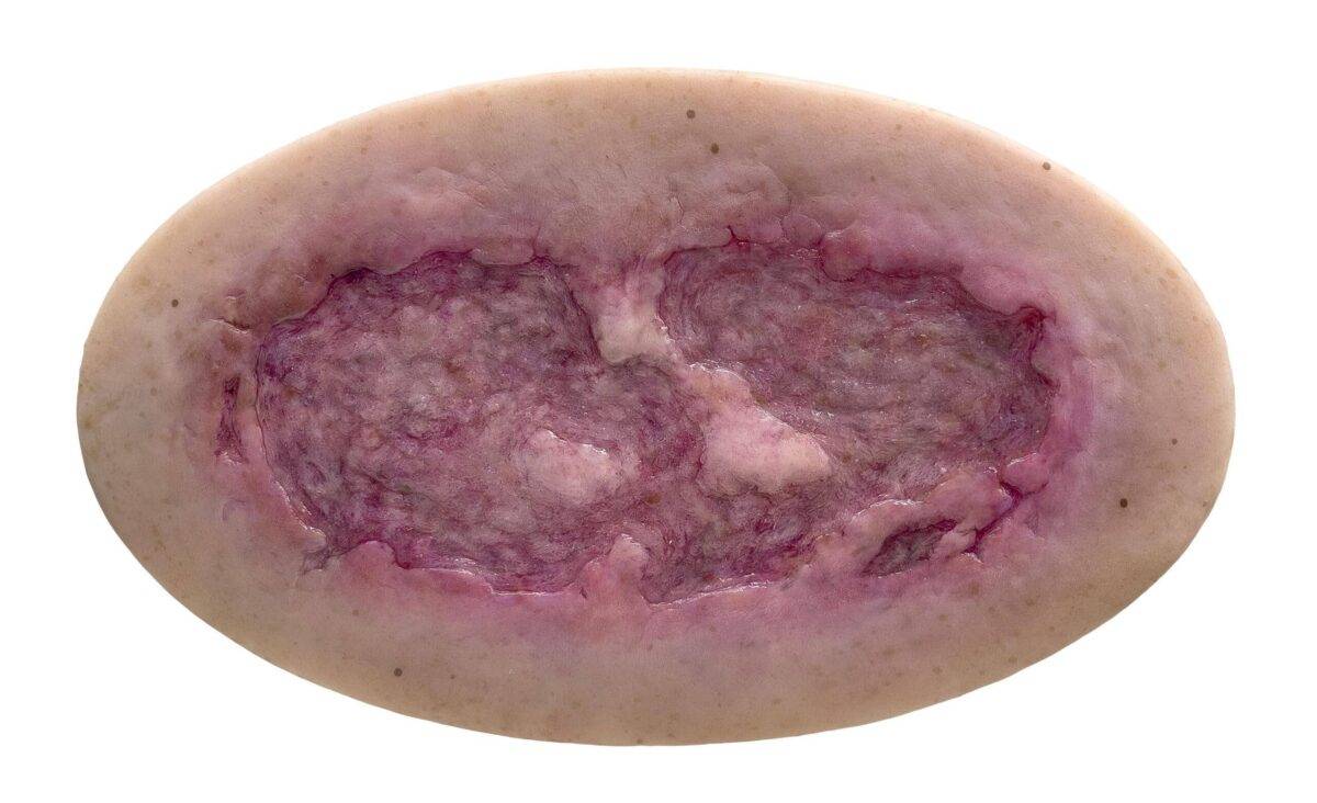 Das Modell „Stick-On Large Ulcus Cruris" von MEDICAL FX Germany simuliert ein großflächiges Unterschenkelgeschwür, typisch für venöse Insuffizienzen oder andere zirkulatorische Er…