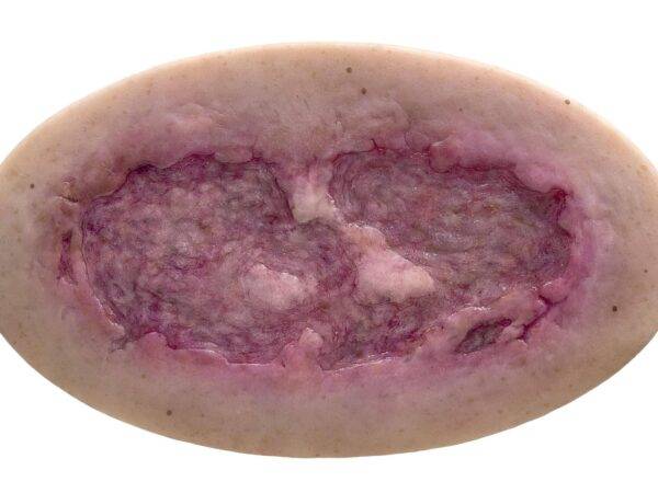 Das Modell „Stick-On Large Ulcus Cruris" von MEDICAL FX Germany simuliert ein großflächiges Unterschenkelgeschwür, typisch für venöse Insuffizienzen oder andere zirkulatorische Er…