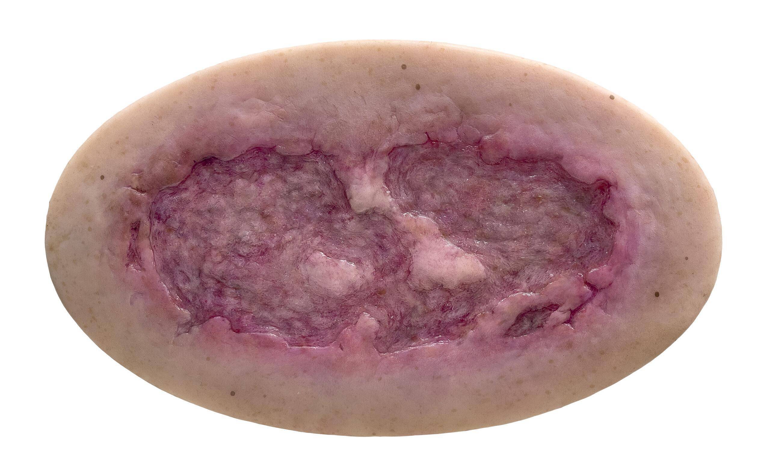 Das Modell „Stick-On Large Ulcus Cruris" von MEDICAL FX Germany simuliert ein großflächiges Unterschenkelgeschwür, typisch für venöse Insuffizienzen oder andere zirkulatorische Er…