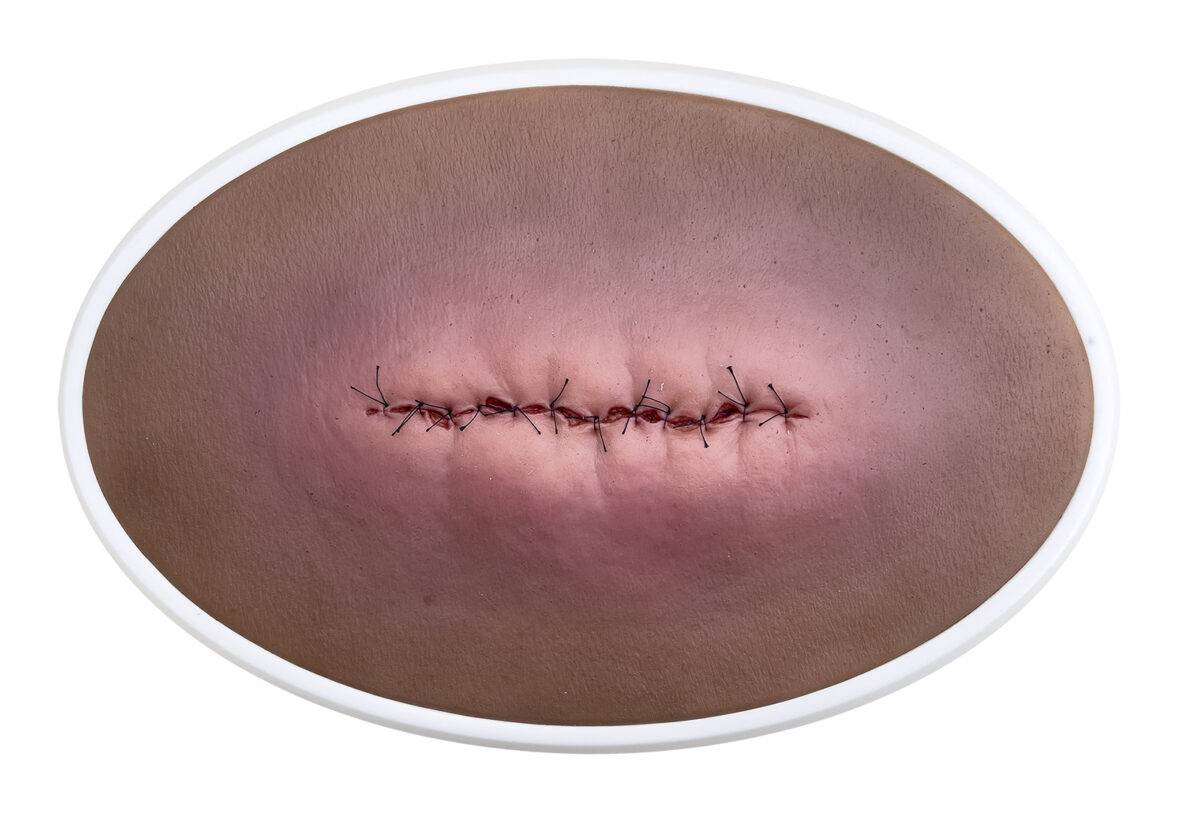 lq op wunde entzuendet geschlossen 2