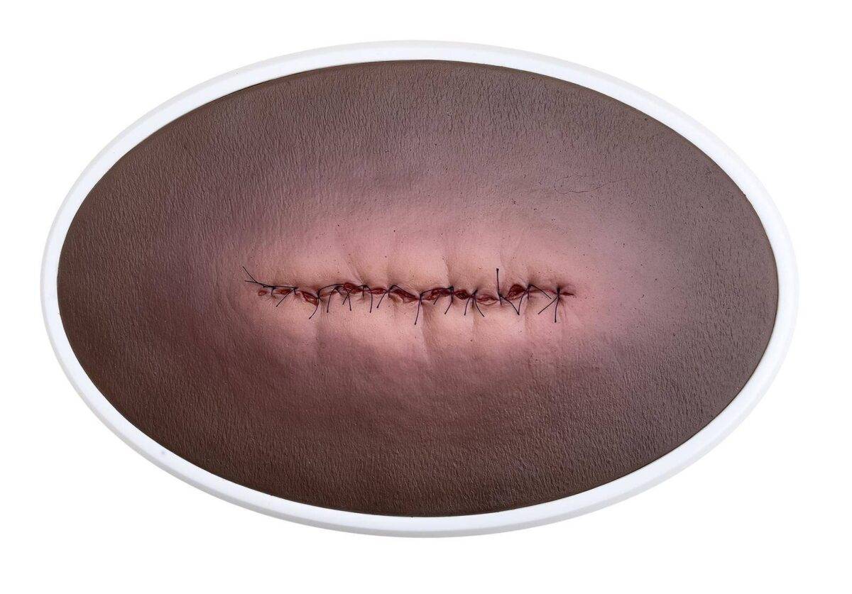 lq op wunde entzuendet geschlossen 3