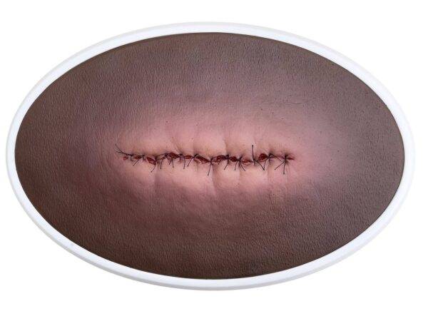 lq op wunde entzuendet geschlossen 3