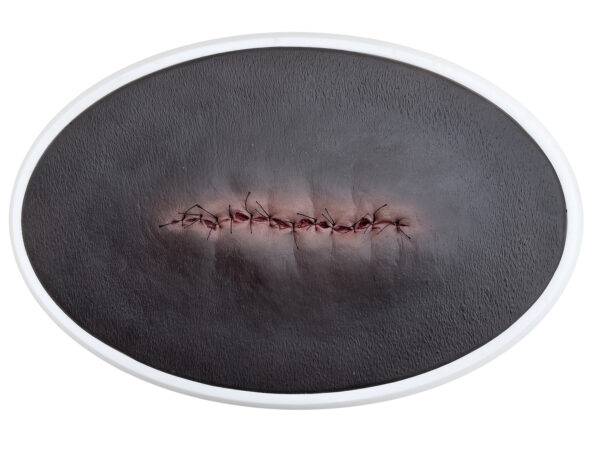 lq op wunde entzuendet geschlossen 4