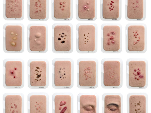Set aus 23 Pocketwunden - Hautveränderungen