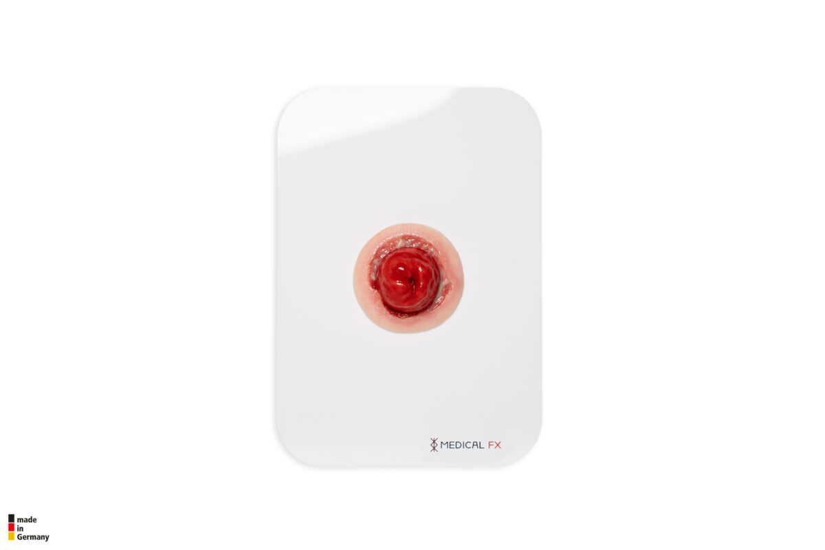 Sticket Stomaausbuchtung Stoma mit Dehiszenz