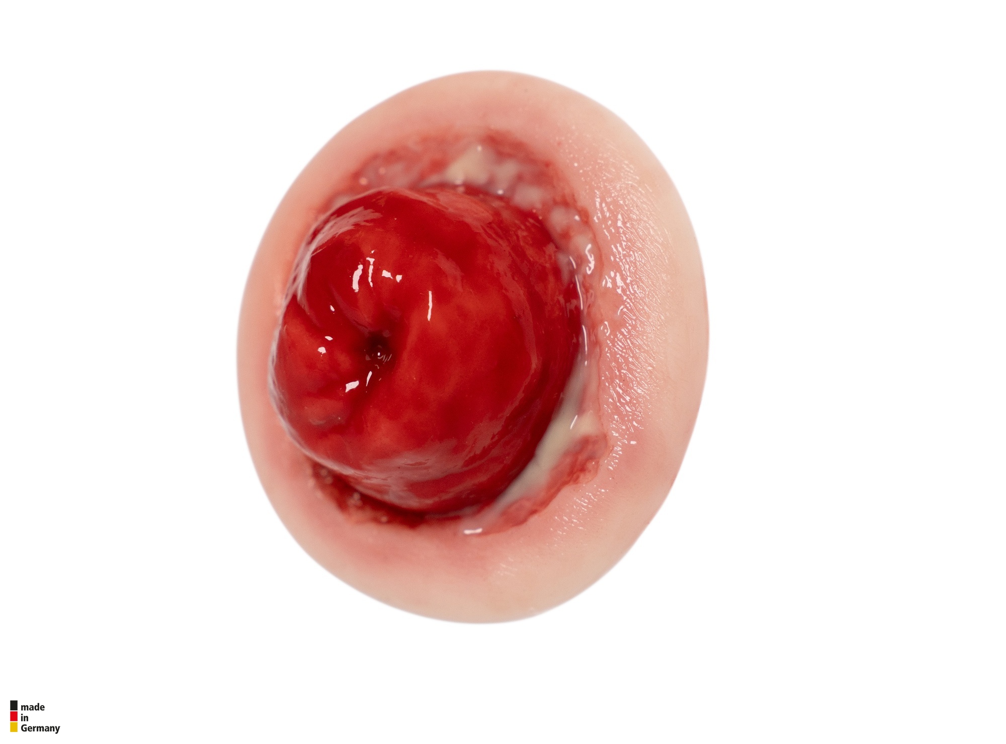 Sticket Stomaausbuchtung Stoma mit Dehiszenz – Bild 1