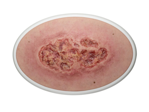 Frame Model Leg Ulcer