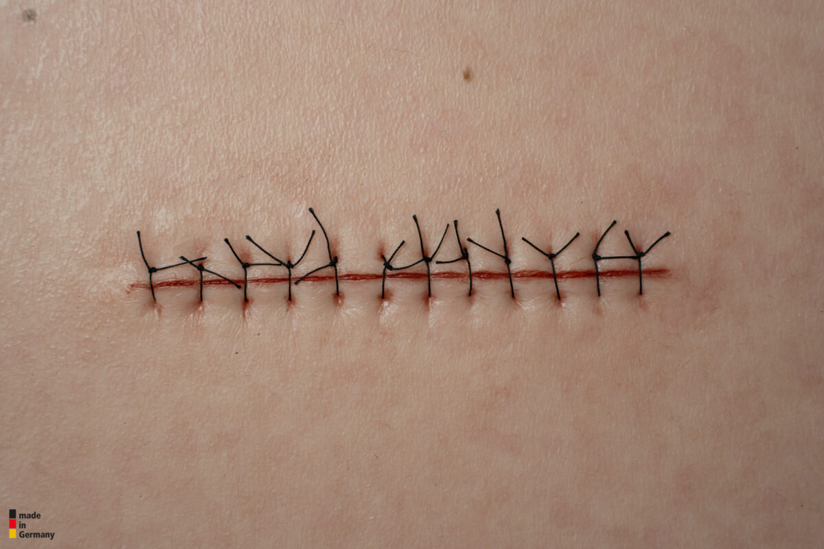 Rahmenmodell Operationswunde mit Naht ohne Entzündungserscheinungen