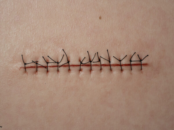 Rahmenmodell Operationswunde mit Naht ohne Entzündungserscheinungen – Bild 4