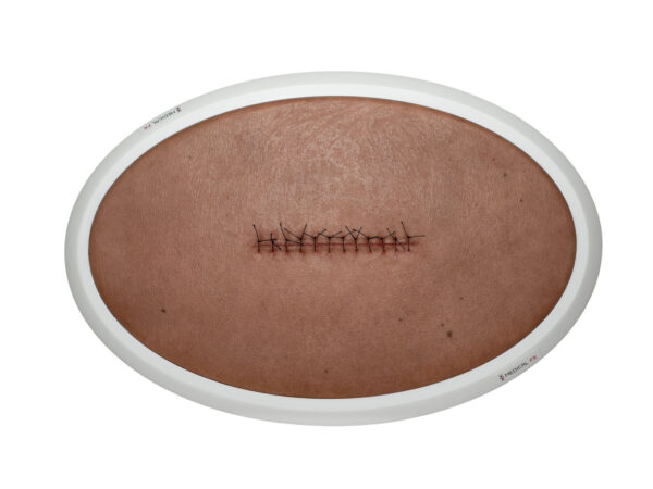 Rahmenmodell Operationswunde mit Naht ohne Entzündungserscheinungen – Bild 5