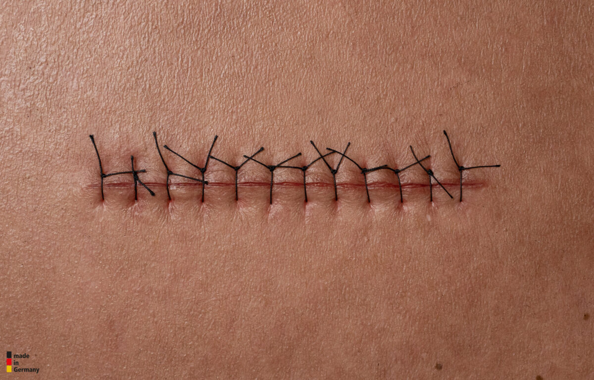 Rahmenmodell Operationswunde mit Naht ohne Entzündungserscheinungen