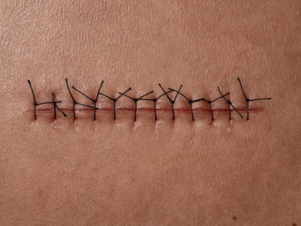 Rahmenmodell Operationswunde mit Naht ohne Entzündungserscheinungen – Bild 3