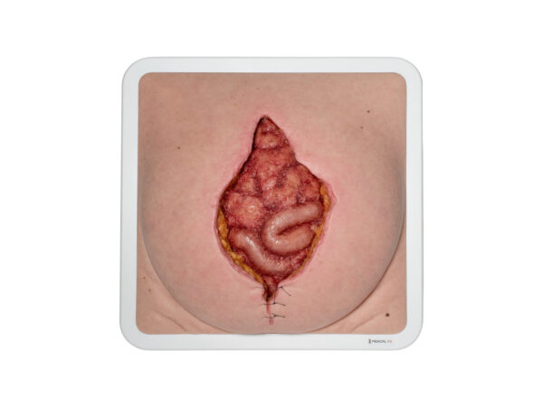 Frame Model Burst abdomen