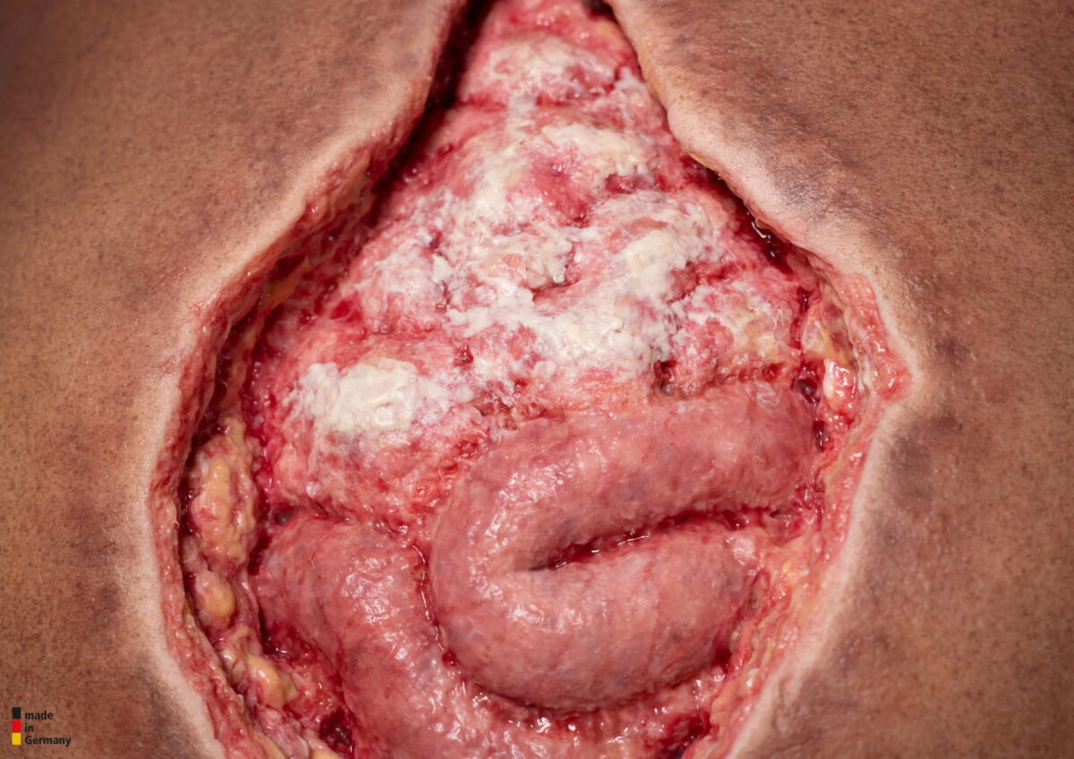 Rahmenmodell Platzbauch