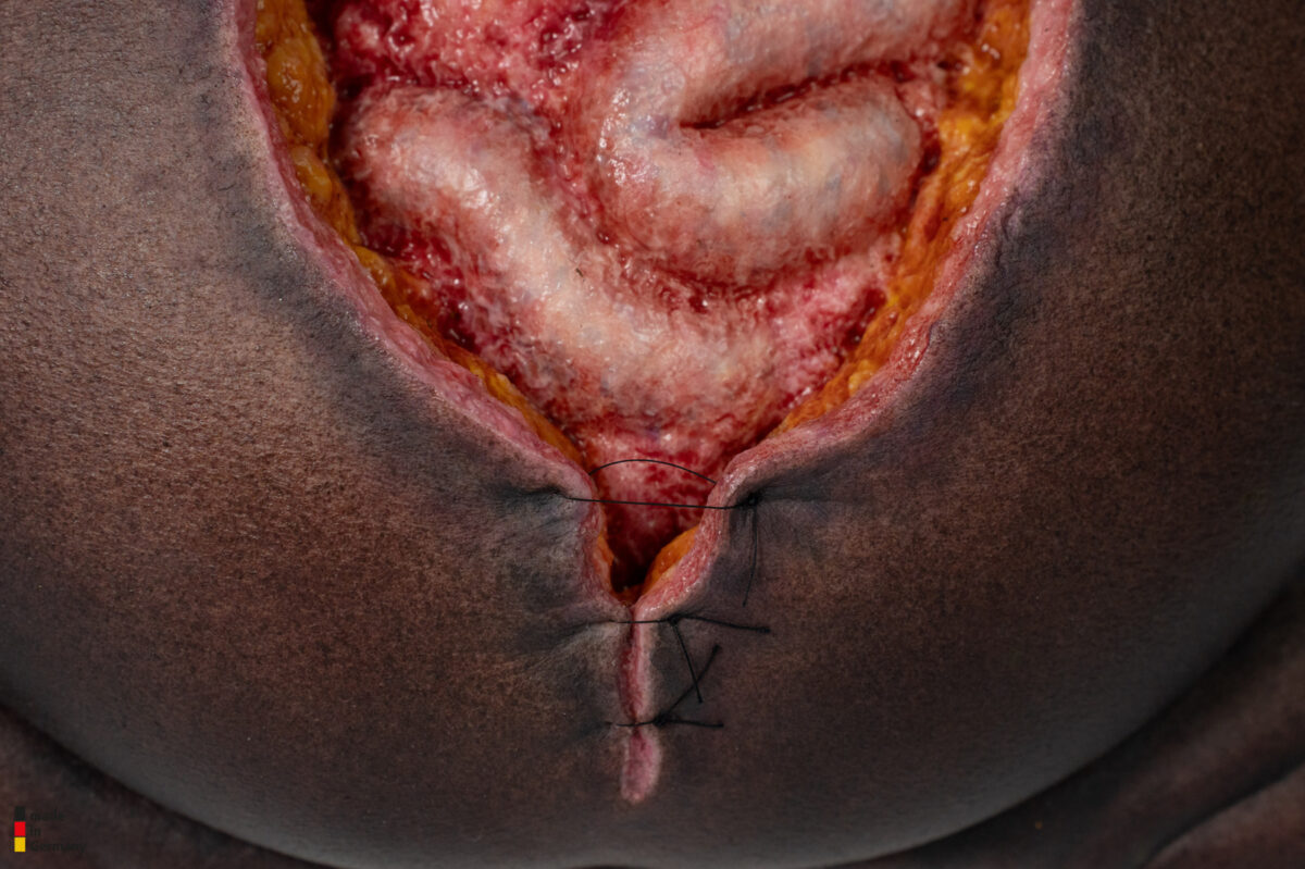 Rahmenmodell Platzbauch