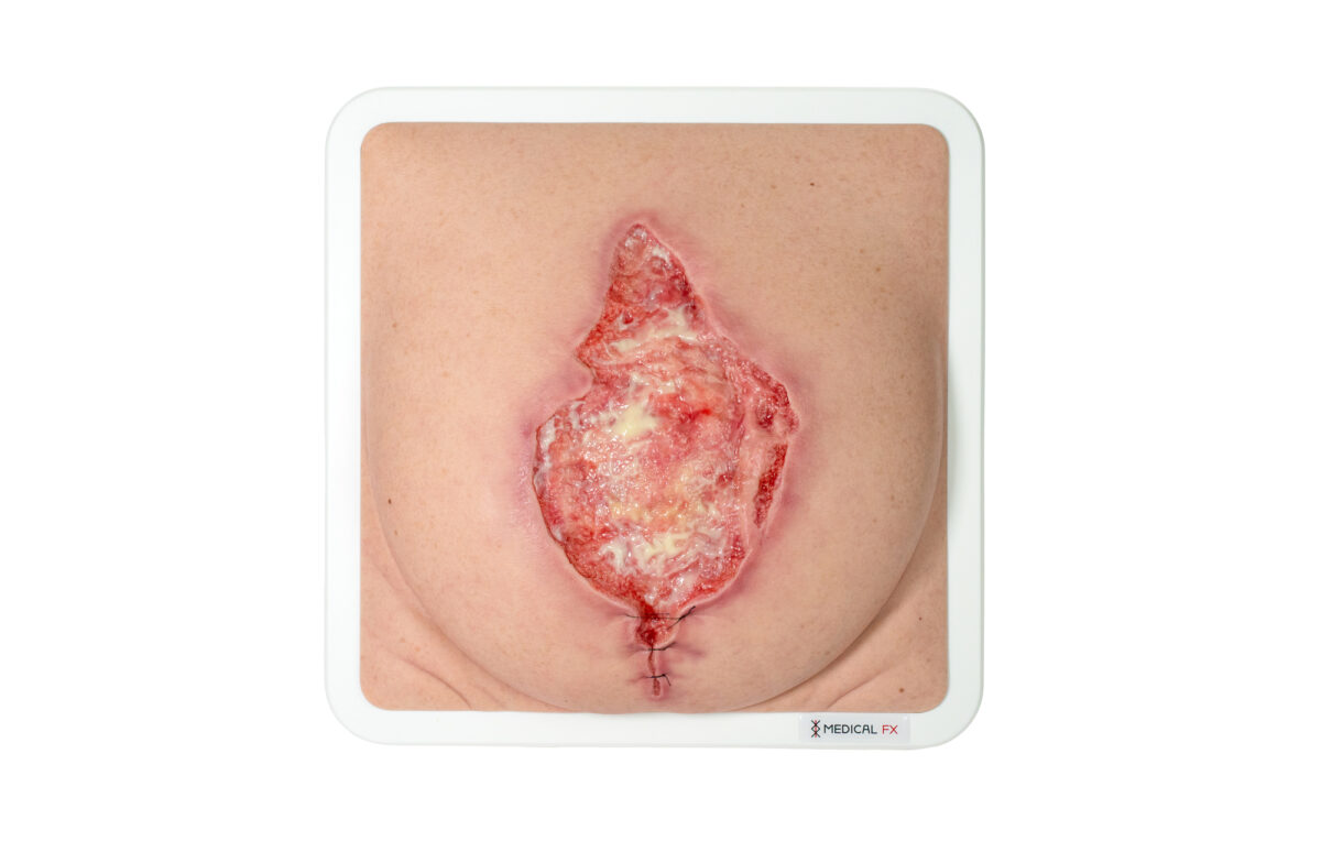 Rahmenmodell Platzbauch mit Granulationsgewebe