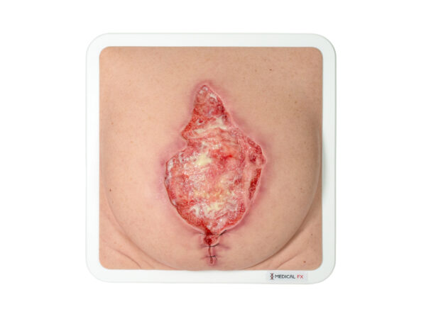Rahmenmodell Platzbauch mit Granulationsgewebe – Bild 7