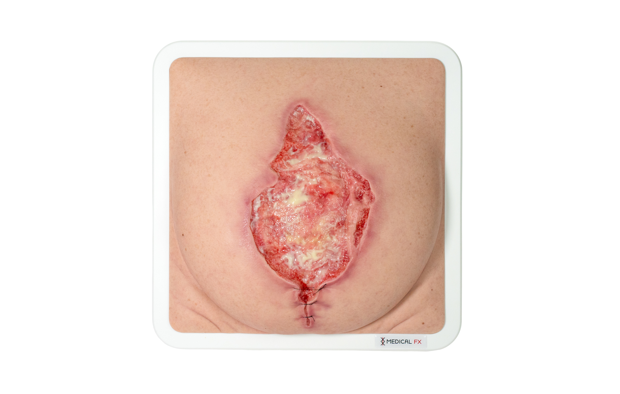 Rahmenmodell Platzbauch mit Granulationsgewebe – Bild 7