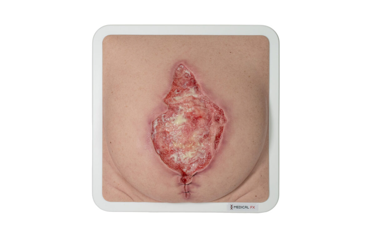 Frame Model 육아 조직이 있는 파열된 복부