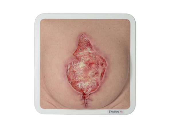 Frame Model 육아 조직이 있는 파열된 복부 - Image 7