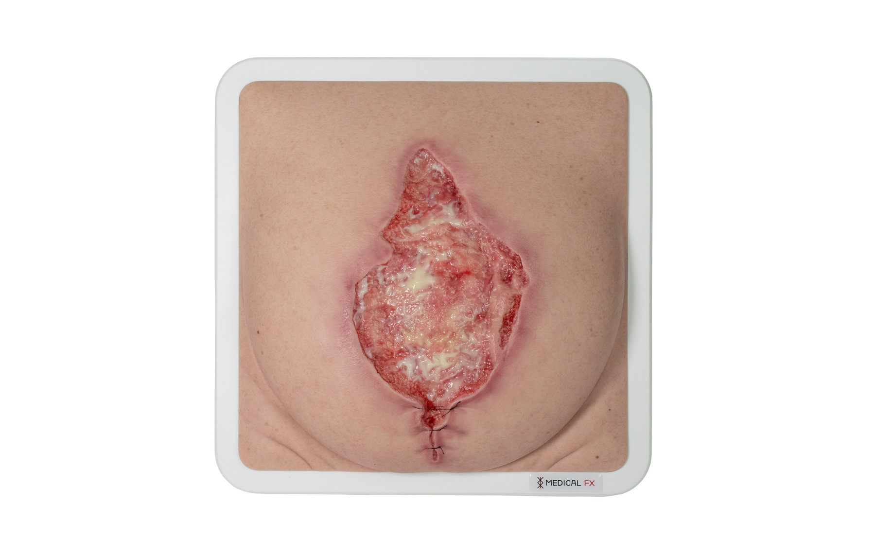 Frame Model 육아 조직이 있는 파열된 복부 - Image 7